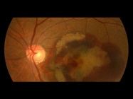 Researchers Successfully Reproduce Retinal Disease Using 