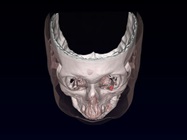 Magnets Implanted Behind Eyes Successful in Treating Nystagmus