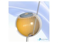 FDA Approves Study for Pixium Vision’s Wireless Implant for Dry-AMD